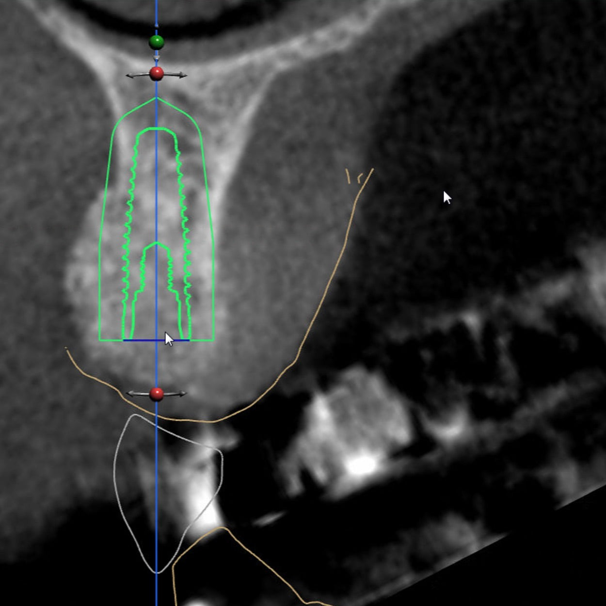 Cross-sectional view of upper alveolar ridge with a dental implant outline in the confines of the bone