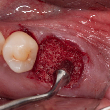 Mentorship in Bone Augmentation - Management of Socket Defects