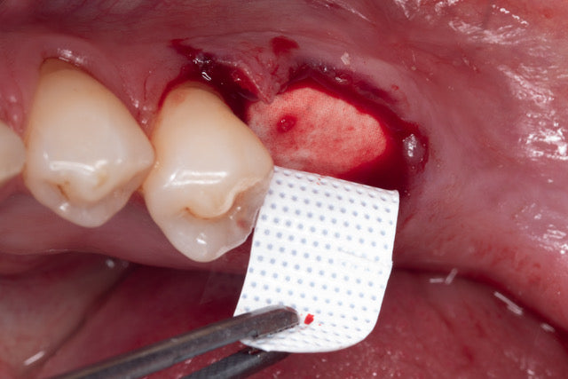 Mentorship in Bone Augmentation - Management of Socket Defects