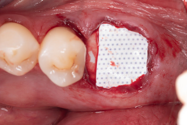 Mentorship in Bone Augmentation - Management of Socket Defects