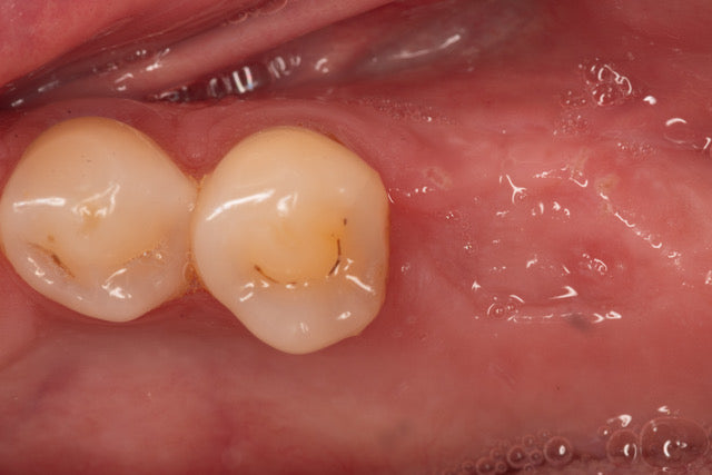 Mentorship in Bone Augmentation - Management of Socket Defects