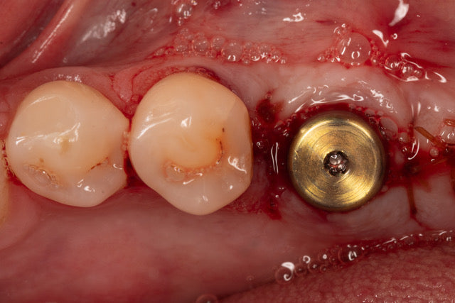 Mentorship in Bone Augmentation - Management of Socket Defects