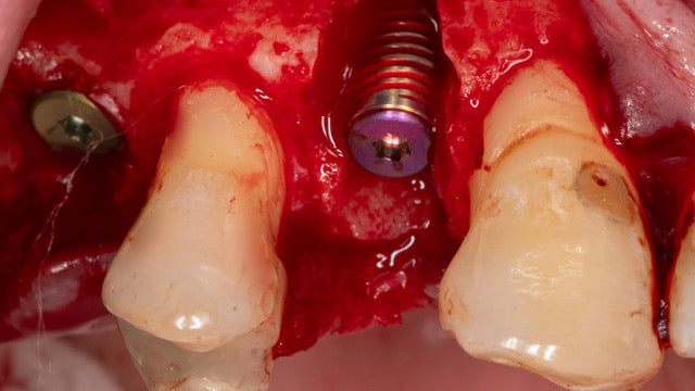 Mentorship in Bone Augmentation - Management of Socket Defects