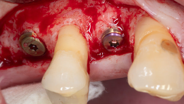 Mentorship in Bone Augmentation - Management of Socket Defects