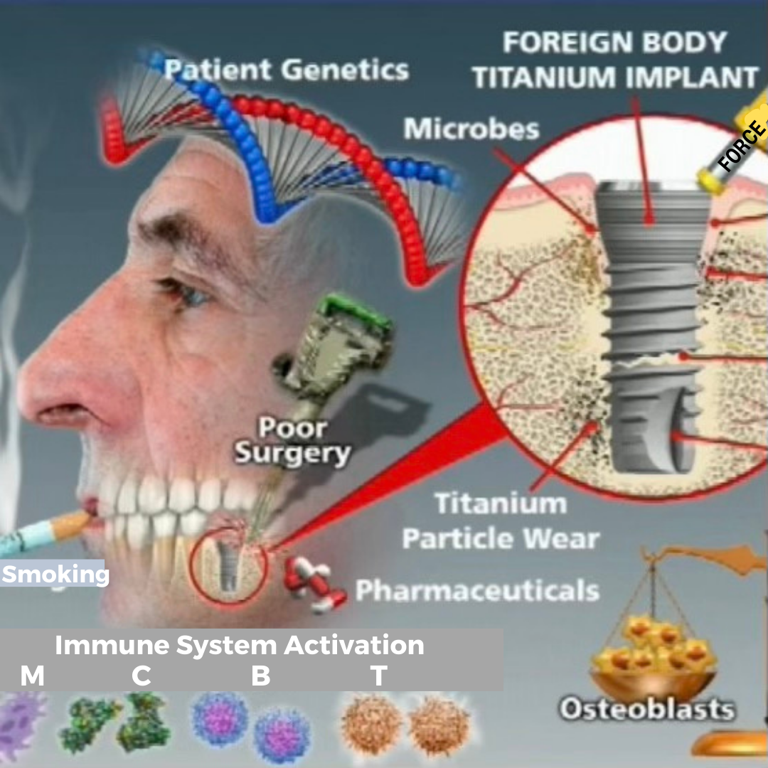 Profile of a man's face with transparent cheek, showcasing teeth and a dental implant in the jaw. Magnified image of the implant in bone with microbes and titanium particles. Larger image of DNA with "patient genetics." Images of cells under "immune system activation." Capsules labeled "pharmaceuticals." Scale with osteoblasts in the lower right