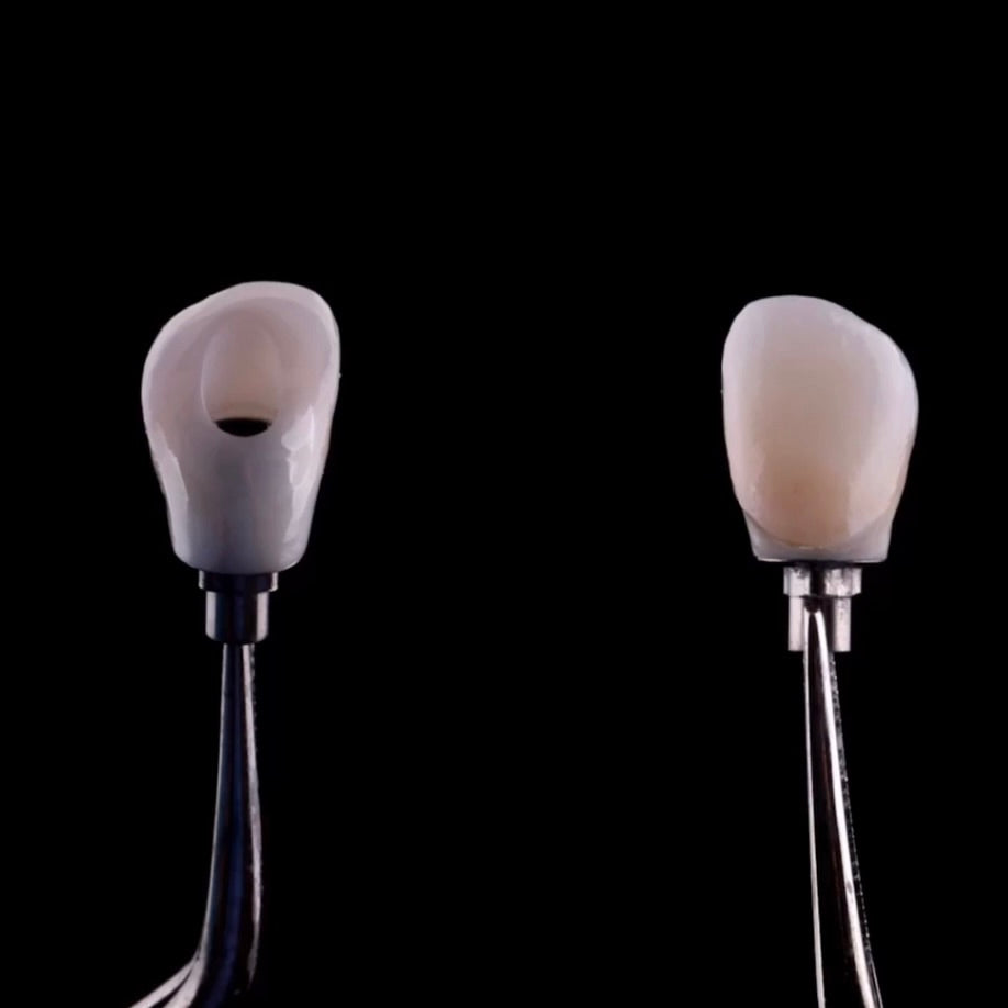 Two images of an implant retained crowns held by pliers. The photo in the left is a lingual view and the photo on the right is a buccal view.