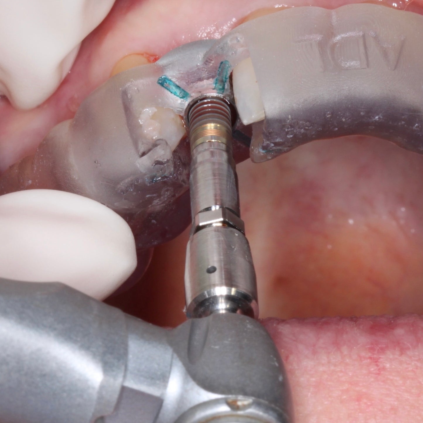 A surgical handpiece inserting a dental implant through a guide prepared using digital workflow