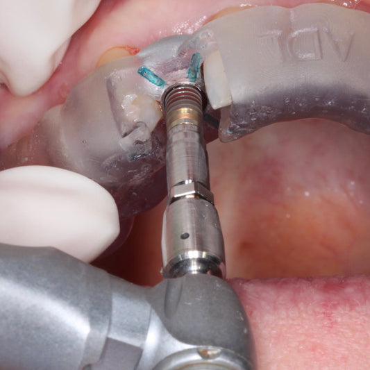 A surgical handpiece inserting a dental implant through a guide prepared using digital workflow