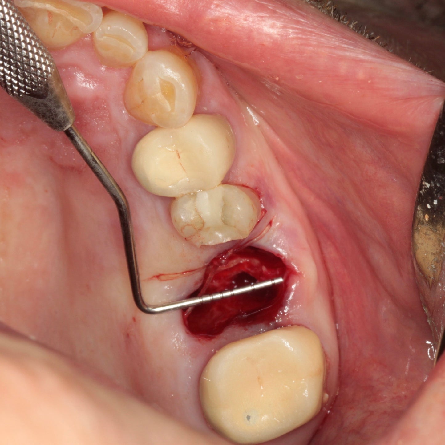 Occlusal view of upper jaw with a fresh extraction site and a periodontal probe