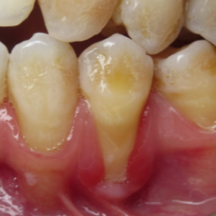 Surgery Live Streaming: Connective Tissue Graft November 13, 2024 Recording