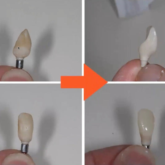 4 photos of a temporary implant-supported crown during the various stages of development of the emergence profile and polishing