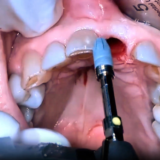 Surgery Live Streaming: Extraction and Immediate Implant Placement February 28, 2025 Recording