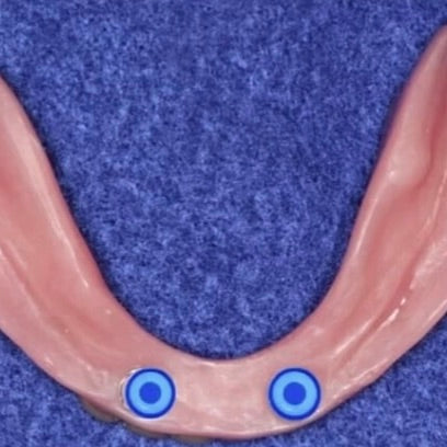 Mandibular overdenture with locator attachment in the intaglio surface