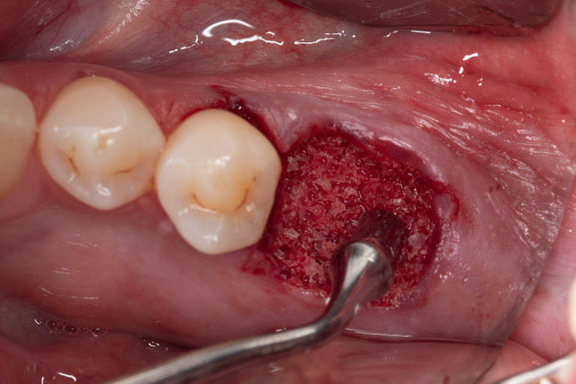 Surgery Live Streaming: Extraction and Immediate Implant Placement February 28, 2025 Recording