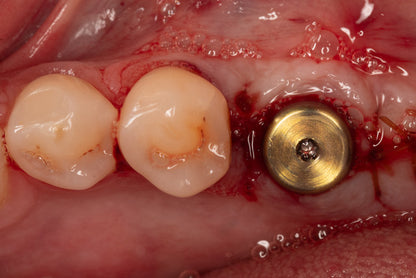 Mentorship in Bone Augmentation - Management of Socket Defects