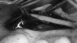 Surgery Live Streaming: Connective Tissue Graft November 13, 2024 Recording