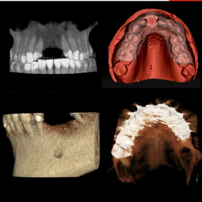 Images of a transparent 3D rendering of a maxillary arch CBCT with missing front teeth, Bone textured 3d rendering CBCT with missing posterior teeth, Occlusal view of the maxillary arch from a CBCT and intra-oral scan of a maxillary arch with a surgical guide replacing a missing front tooth