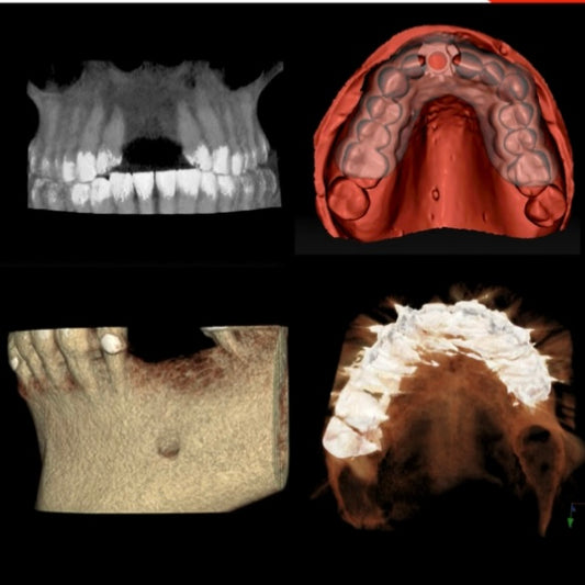 Images of a transparent 3D rendering of a maxillary arch CBCT with missing front teeth, Bone textured 3d rendering CBCT with missing posterior teeth, Occlusal view of the maxillary arch from a CBCT and intra-oral scan of a maxillary arch with a surgical guide replacing a missing front tooth