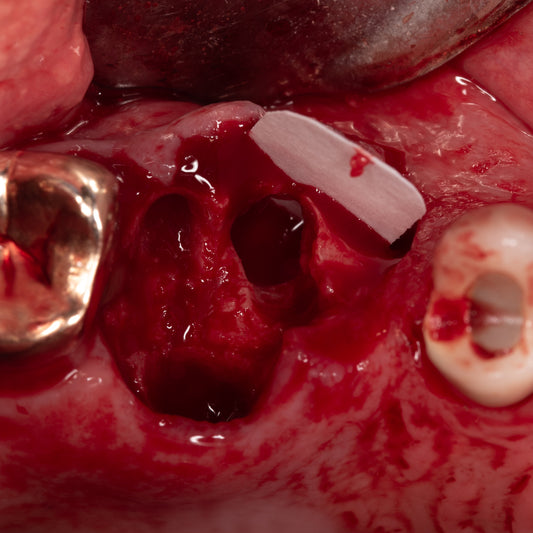 Surgery Live Streaming: Implant Placement and Extraction with Socket Grafting