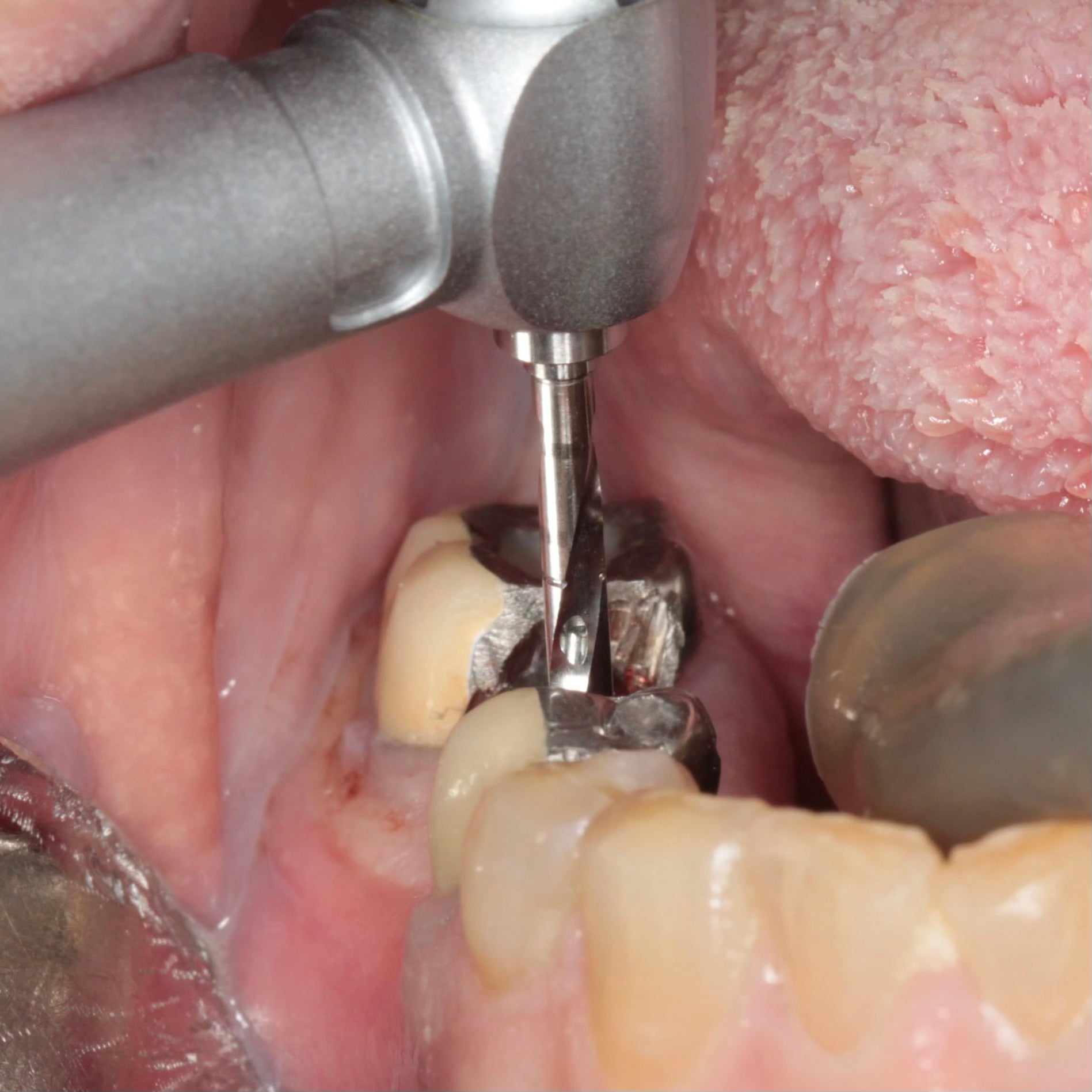 Intraoral photo of mandibular posterior teeth with a dental implant handpick and a drill resting on the missing tooth site