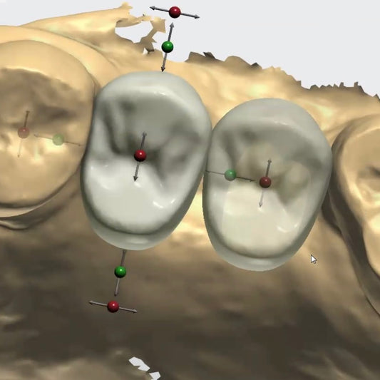 Virtual premolars designed by a digital workflow on an intra-oral scan of the maxillary teeth