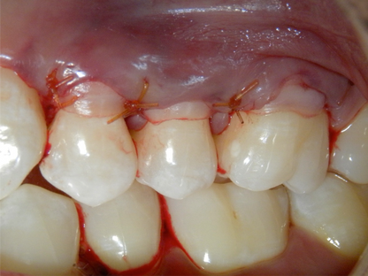 Surgery Live Streaming: Connective Tissue Graft November 13, 2024 Recording