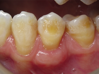 Surgery Live Streaming: Connective Tissue Graft November 13, 2024 Recording