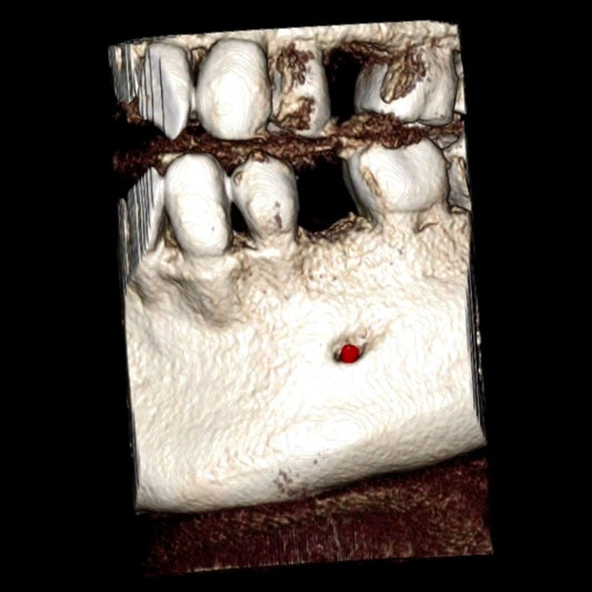 3D rendering from a CBCT showing missing left second premolar tooth and the location of the mental foramen and the mental nerve