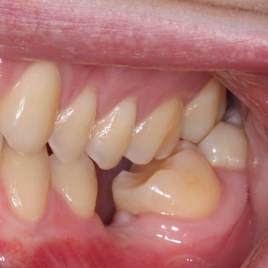 Photo of teeth in occlusion with a missing tooth and tipped molars behind